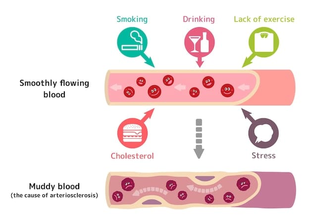 A visual representation of the correlation between high sodium intake, increased blood pressure, and the risk of heart disease, depicted through infographics and simple diagrams.